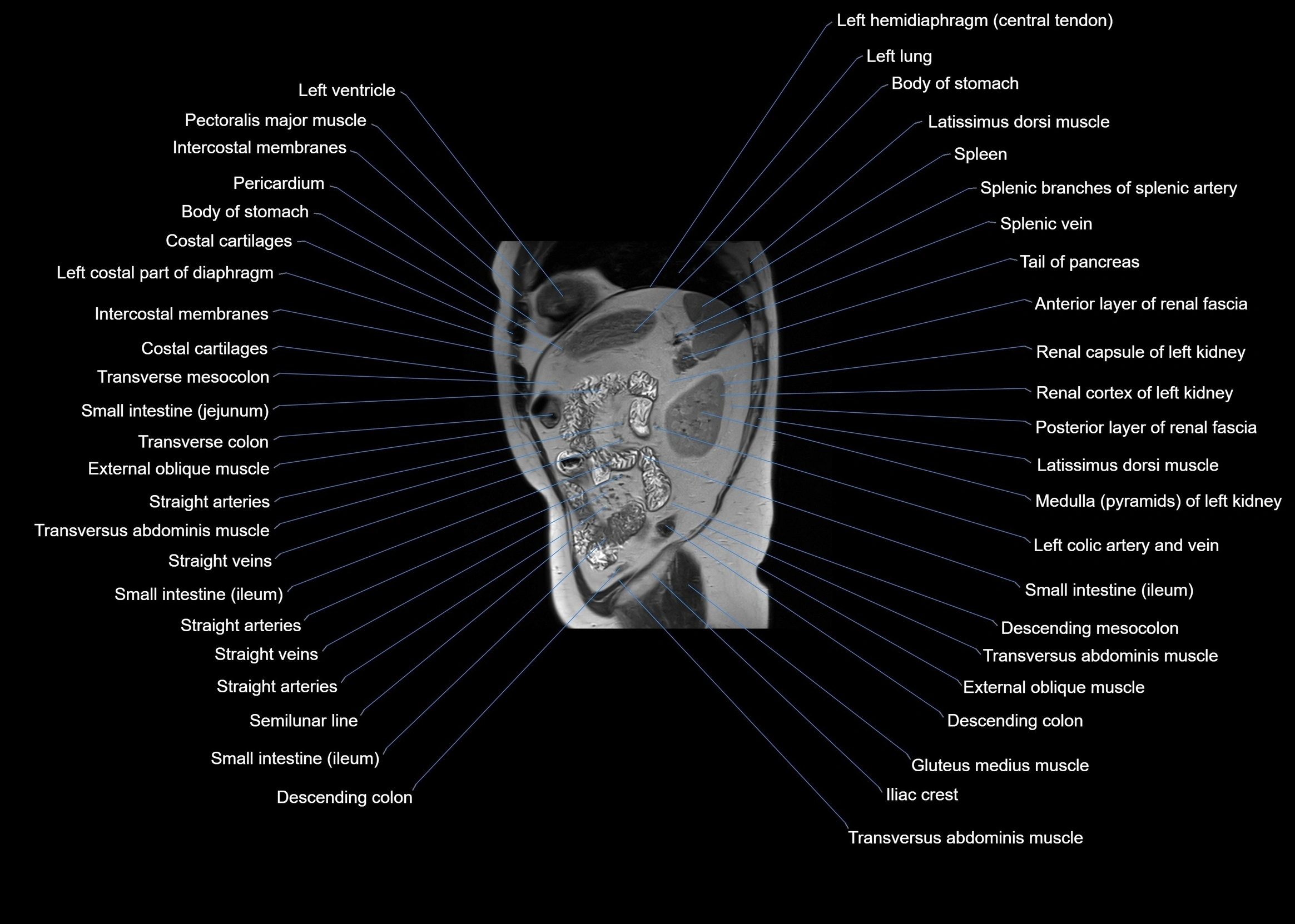 MRI abdomen sagittal cross sectional anatomy  radiology  image-img-00001-00054.webp